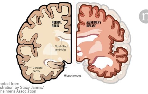 Apa yang menyebabkan demensia? - Alzheimer Indonesia